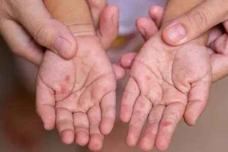 4 yaşlı Rüfətin qızılcadan ölməsinin təfərrüatı