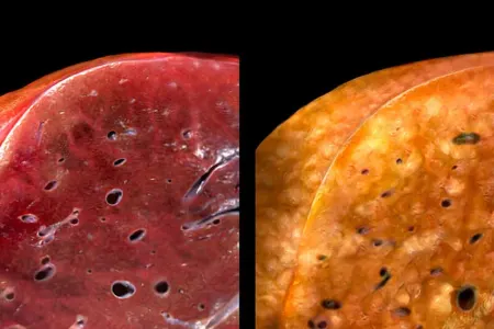 Qaraciyər yağlanmasının - 5 əlaməti