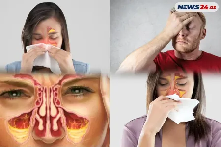 Qaymoritin ev şəraitində müalicəsi mümkündür? - Həkim açıqladı