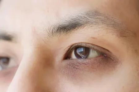 Göz altında qara dairələr - Ciddi xəstəliklərin 5 gizli əlaməti