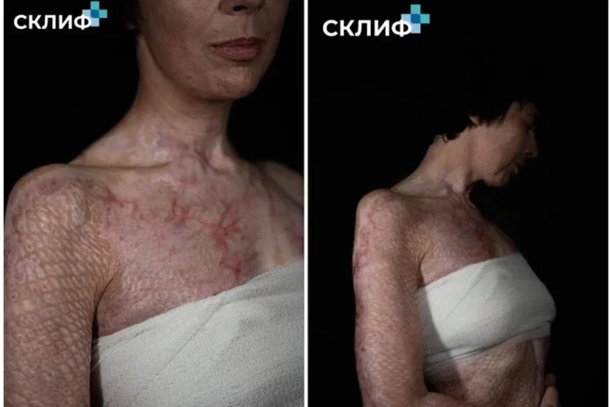 Yeməyini bişirərkən dərisinin 60%-ni - YANDIRDI