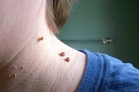 Bədənimizdəki xallar xərçəngdən xəbər verə bilər