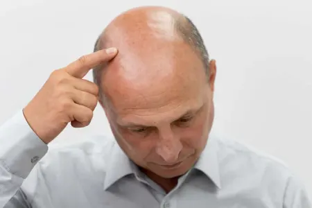 Keçəlliyin qarşısını almaq üçün beş üsul açıqlandı