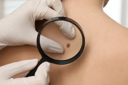 Dəri xərçənginin inkişaf riskini artıran faktorlar açıqlandı