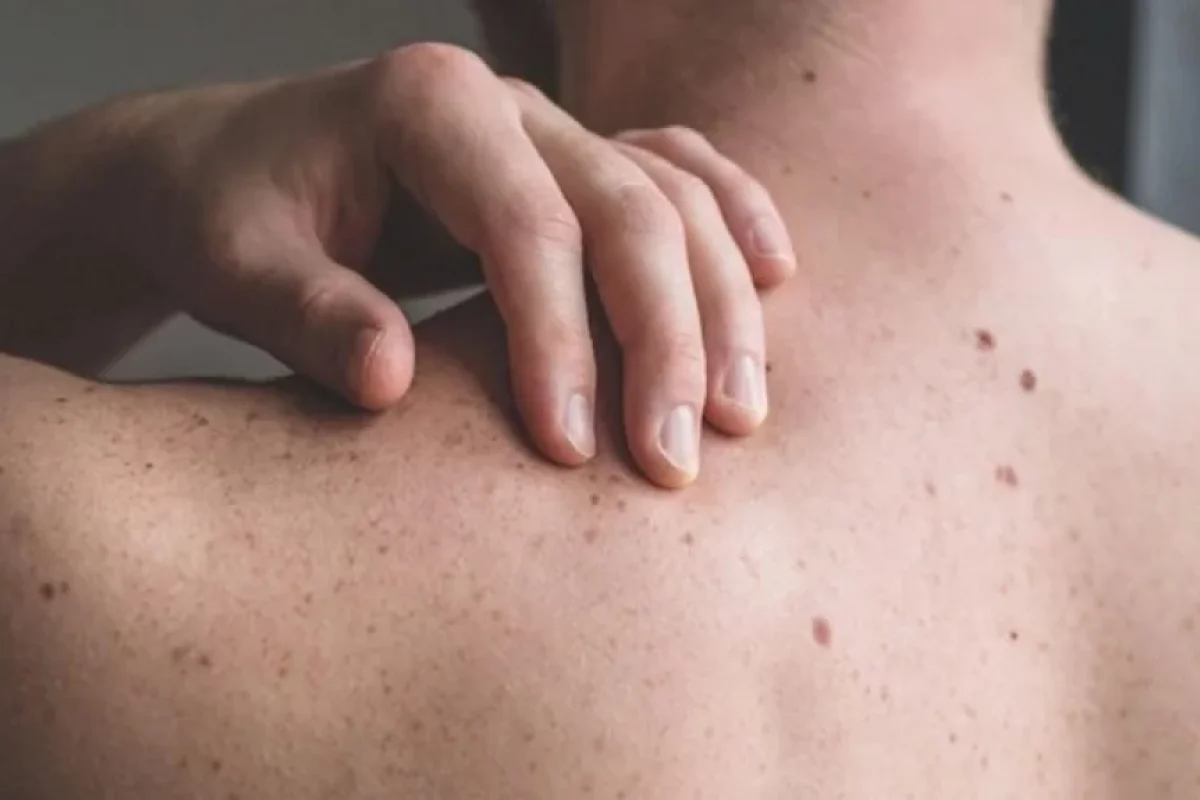 Bədəndəki xallar - götürülə bilərmi?