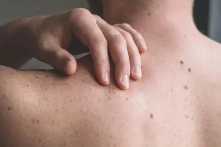 Bədəndəki xallar - götürülə bilərmi?