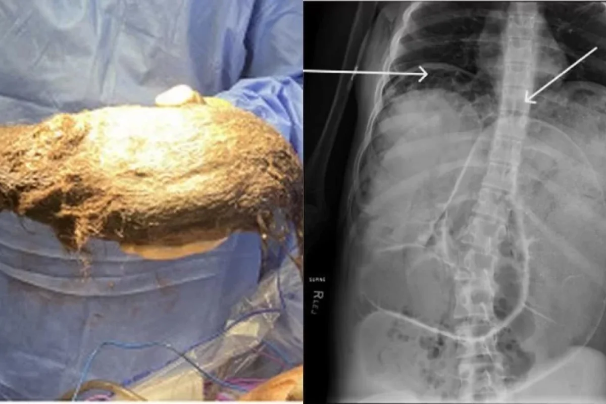 Mədəsindən çıxanlar həkimləri - ŞOKA SALDI