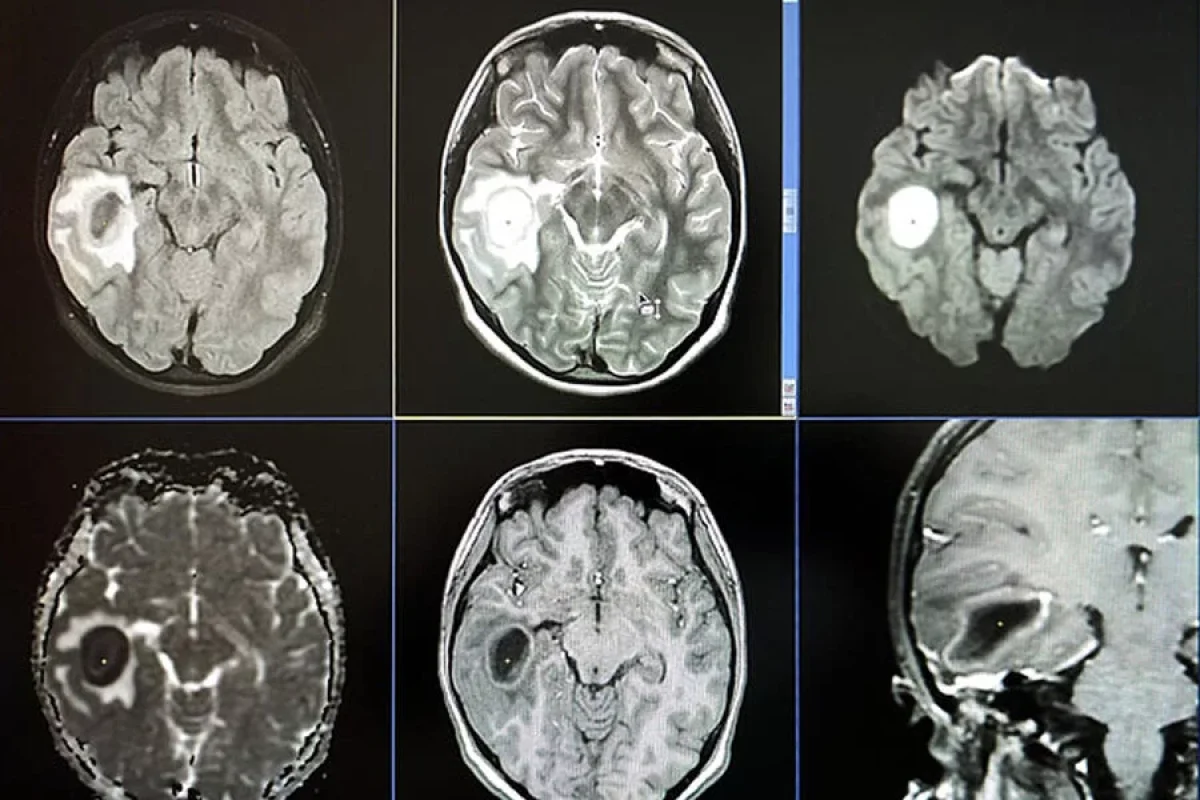 Qulağı ağrayan məktəbli qızın - BEYNİNDƏ...