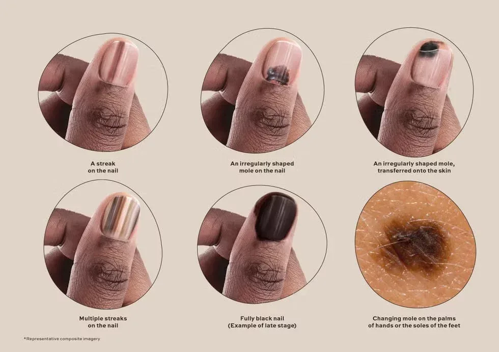 Dırnaqlardakı bu izlər xərçəngin ilk XƏBƏRÇİSİDİR - DİQQƏT