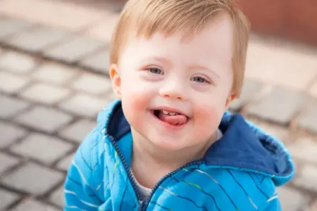 Daun sindromunun müalicəsi üçün - mühüm KƏŞF