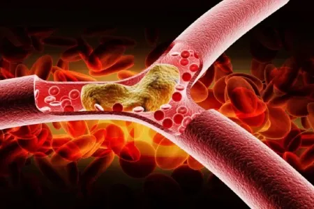 Piylənmə və diabet qədər təhlükəli - Damar xəstəliklərini artırır