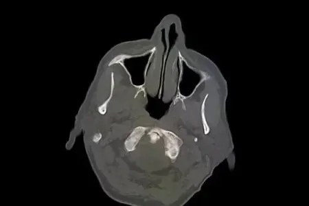 "Yarım beyinlə" yaşayıb: - İllər sonra öyrəndi