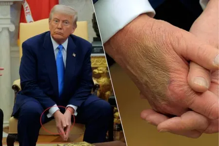 Trampın əlindəki ləkənin sirri – - Ağ Ev açıqladı