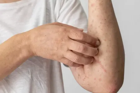 Uşaq qızılcadan öldü