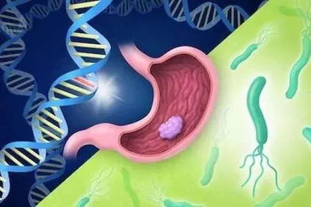 Alimlər mədə xərçənginin diaqnozu və müalicəsi üçün - yeni üsul tapıblar