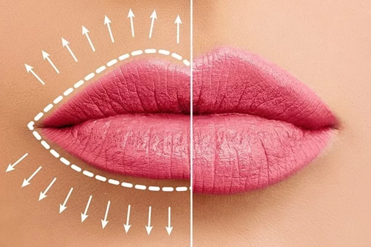 Dodaq dolğusundan sonra - nələrə diqqət edilməlidir?