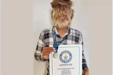 Cəmi 50 insanda aşkar edilib - Adı "Guinness"in kitabına düşdü