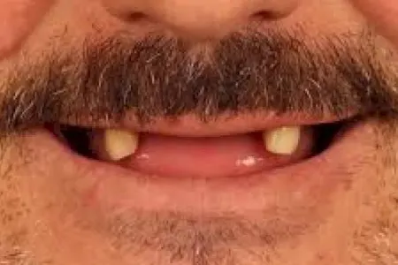 Qorxudan dişləri töküldü