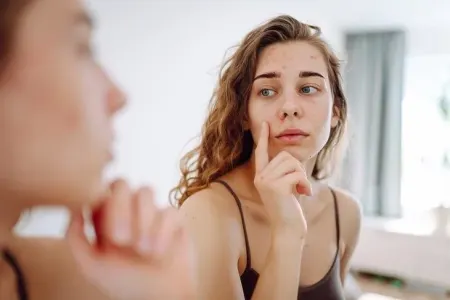 Sızanaqların müalicəsi üçün - QIZIL QAYDA