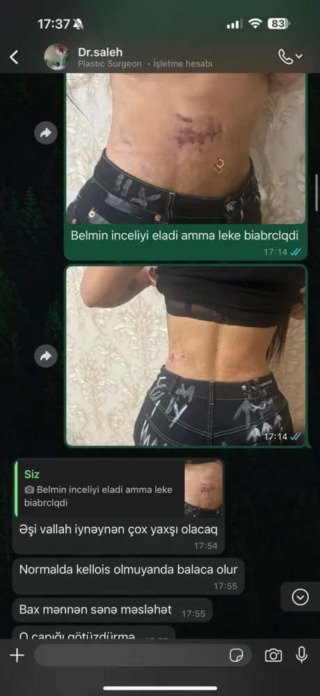 Model Aytən Muradovanın bədəni çürüyür