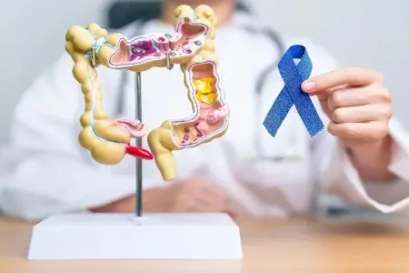 Yoğun bağırsaq xərçəngi artır: - Mütəxəssislər “qatıq” tövsiyə edir