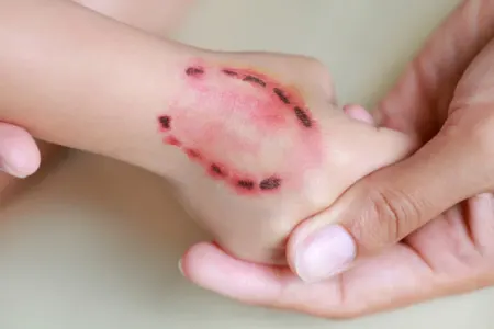 8 yaşlı uşaq 10 yaşlı oğlanı dişləyib öldürdü