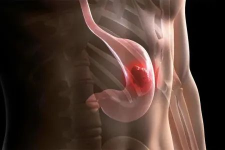 Mədə xərçənginə səbəb olan beşlik