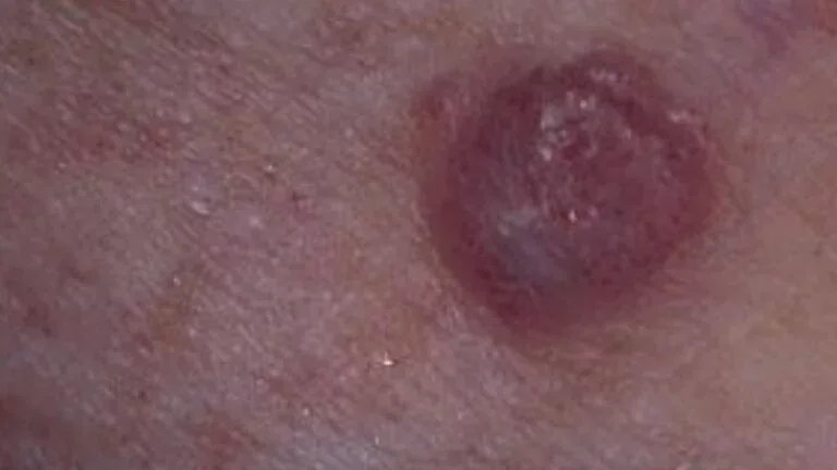 Sızanaq rənginiz belədirsə, - xəstəxanaya tələsin