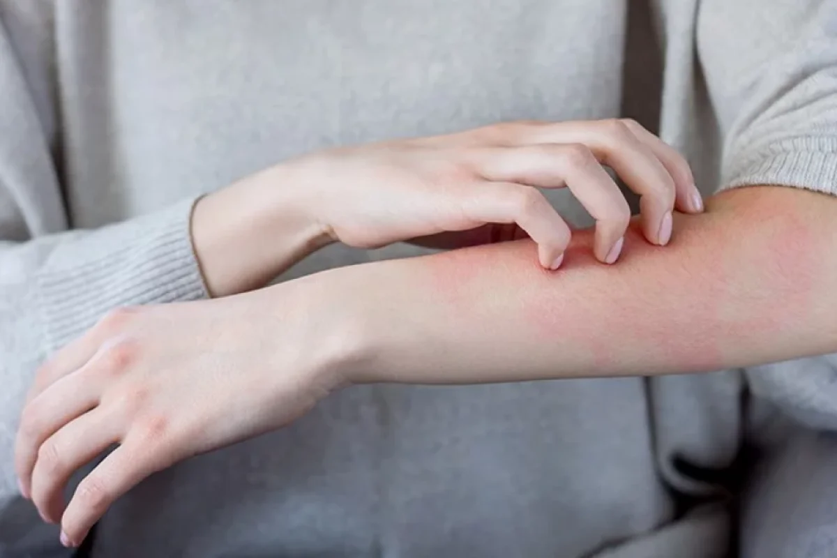 Allergiyaya səbəb olan məşhur - QİDA