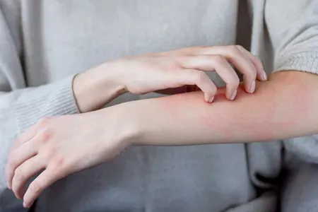 Allergiyaya səbəb olan məşhur - QİDA