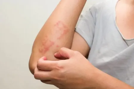 Dəri zədələnməsi qida allergiyasına səbəb ola bilər - ARAŞDIRMA