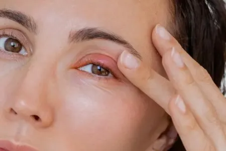 Qızarmış göz qapaqları bu xəstəliyin əlamətidir