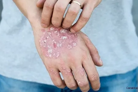 Dərinin ən çətin sınağı: - Sədəf xəstəliyinə necə nəzarət etməli?