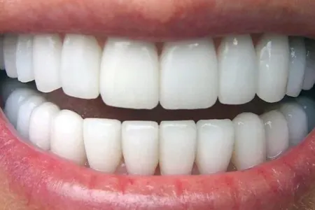 Bu qidalar dişlərdə problem - YARADIR