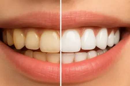 Bu qidalar dişlərinizi səssizcə zədələyə bilər