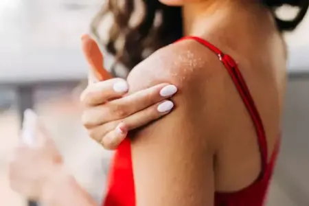 Günəş allergiyasından özünüzü qorumaq mümkündür