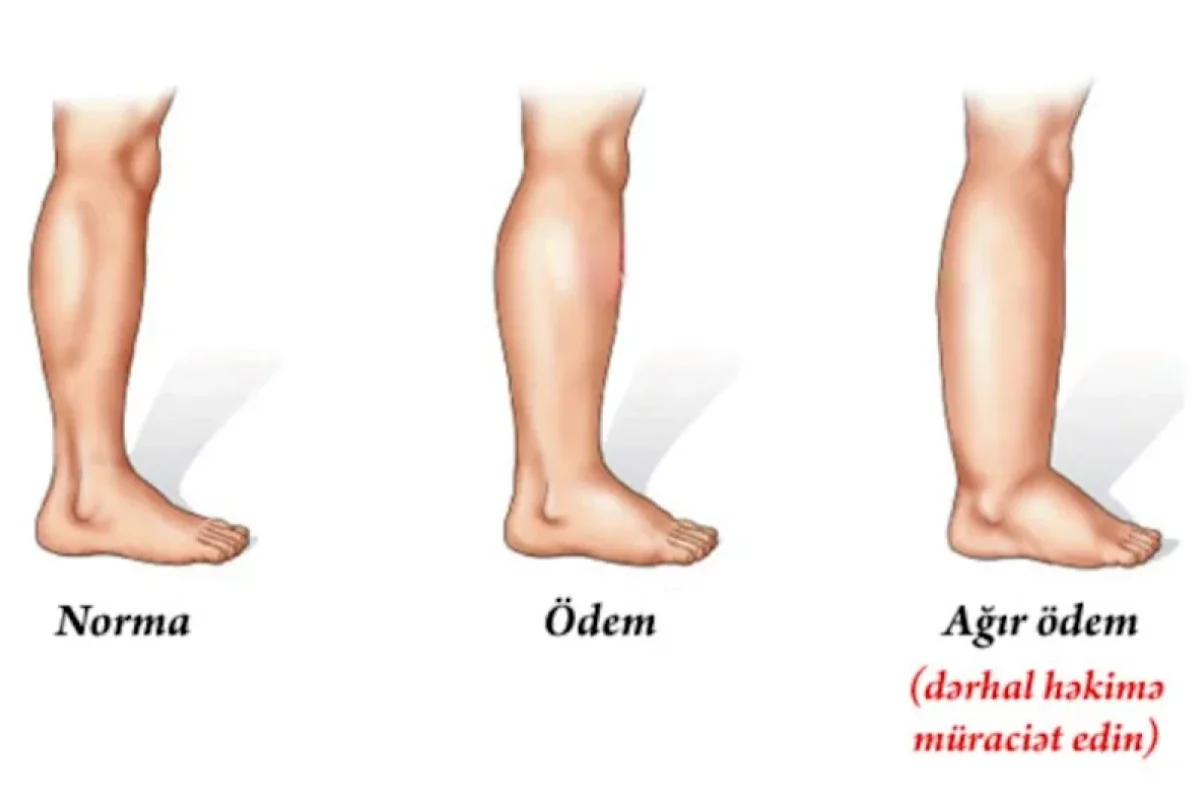 Ayaqlarınız tez-tez şişirsə, MÜTLƏQ OXUYUN: 5 təhlükəli səbəb