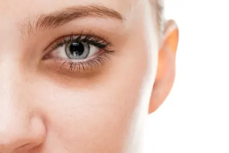 Gözlərinizin altındakı qara dairələr genetikdirsə nə edə bilərsiniz?