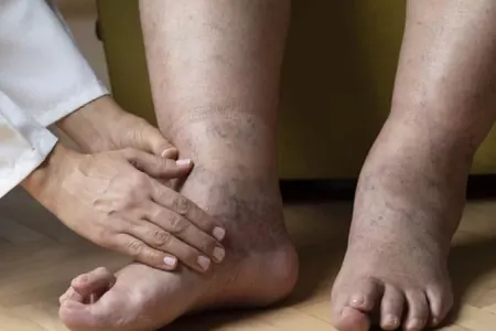 Ödəm nədir, necə atılmalıdır?