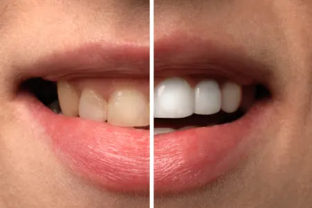 Dişləri çürüdən - 8 QİDA