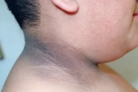 Boyun qaralması nəyin əlamətidir?