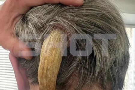 30 yaşlı kişidə "şeytan buynuzu" çıxdı