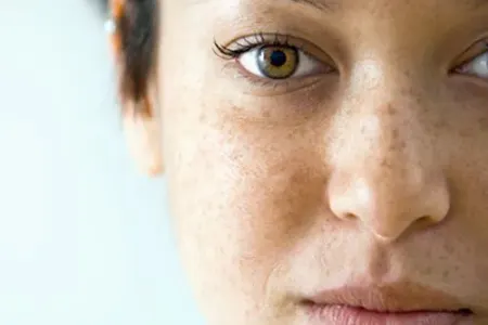 Günəş ləkələrindən qorunmanın - QAYDALARI