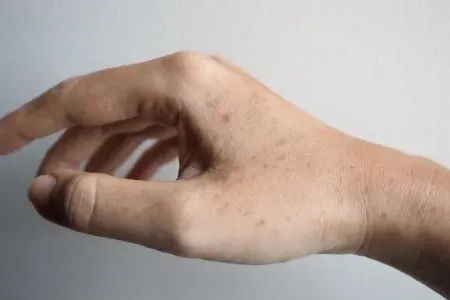 Günəş ləkələrindən qorunmanın qaydaları