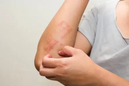 Bu üsulla allergiyadan bir aya - QURTULMAQ OLAR