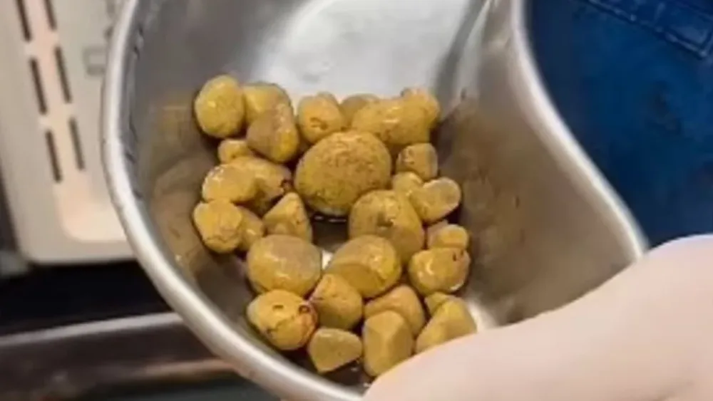 Çoxlu kola içdi, xəstəxanaya yatırıldı - FOTO