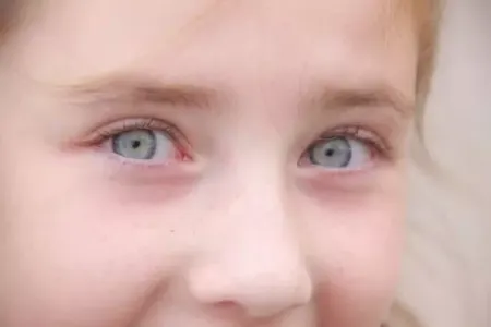 Uşağın görməsinin pisləşdiyini bildirən əlamətlər
