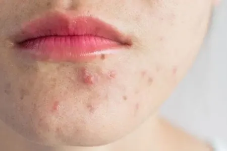 Sızanaqlara qarşı peyvənd hazırlanır