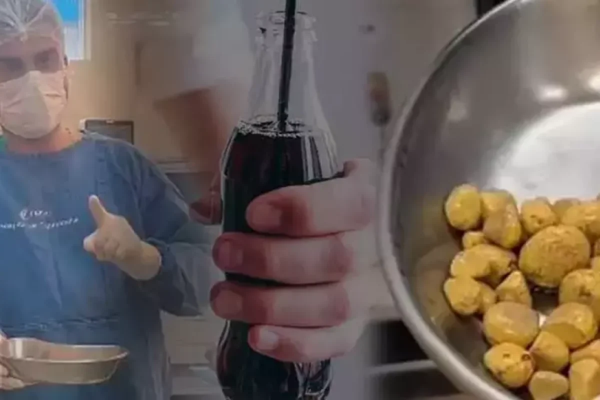 Gündə 3 litr kola içdi, sidik kisəsi daşla doldu – - Sosial mediada viral oldu