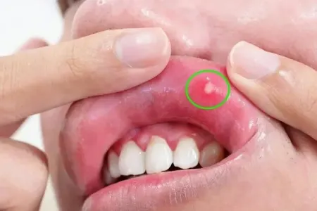 Xərçəngin gözə çarpmayan əlamətləri